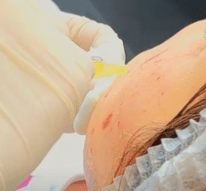 نمونه تزریق مزوژل کلینیک زیبایی الگانت