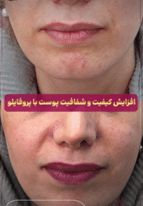 نمونه تزریق مزوژل کلینیک زیبایی الگانت