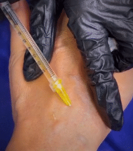 نمونه تزریق مزوژل کلینیک زیبایی الگانت