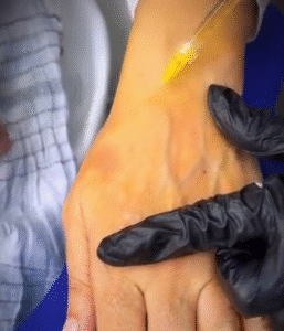 نمونه تزریق مزوژل کلینیک زیبایی الگانت