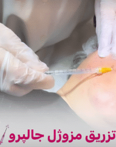 نمونه تزریق مزوژل دکتر زهره حاج حیدری (کلینیک پوست و مو صدف)