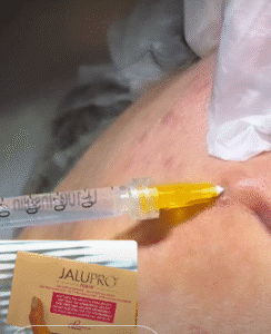 نمونه تزریق مزوژل دکتر زهره حاج حیدری (کلینیک پوست و مو صدف)