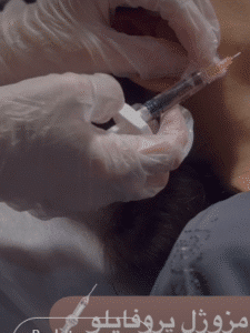 نمونه تزریق مزوژل دکتر زهره حاج حیدری (کلینیک پوست و مو صدف)