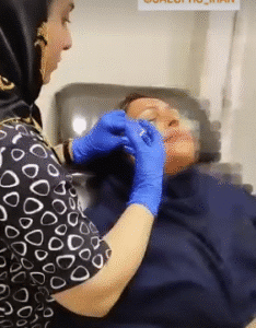 نمونه تزریق مزوژل دکتر رجا قلیان