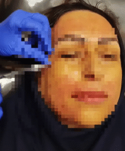 نمونه تزریق مزوژل دکتر رجا قلیان