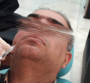 نمونه تزریق مزوژل کلینیک زیبایی برنا (دکتر شایان مهدی کیا)