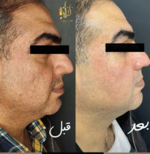 نمونه تزریق مزوژل کلینیک زیبایی برنا (دکتر شایان مهدی کیا)