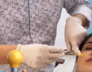 نمونه تزریق مزوژل کلینیک زیبایی برنا (دکتر شایان مهدی کیا)