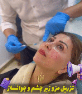 نمونه تزریق مزوژل کلینیک زیبایی برنا (دکتر شایان مهدی کیا)