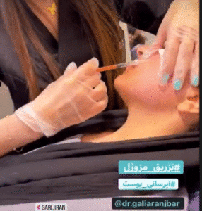 نمونه تزریق مزوژل دکتر گالیا رنجبر