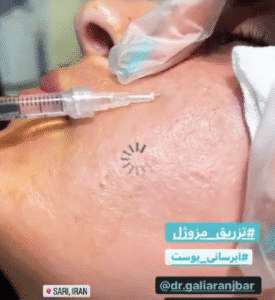 نمونه تزریق مزوژل دکتر گالیا رنجبر