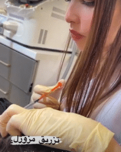 نمونه تزریق مزوژل دکتر گالیا رنجبر