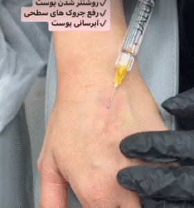 نمونه تزریق مزوژل دکتر فرناز ریوجام