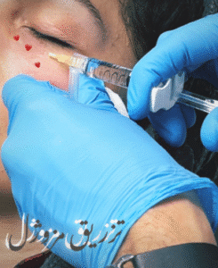 نمونه تزریق مزوژل دکتر محمود جعفری