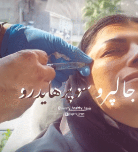 نمونه تزریق مزوژل دکتر محمود جعفری