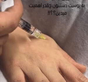 نمونه تزریق مزوژل دکتر محمود جعفری
