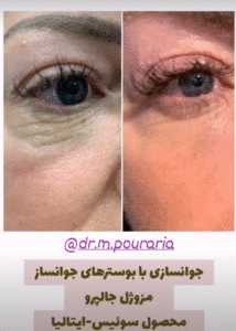 نمونه تزریق مزوژل دکتر محسن پورآریا