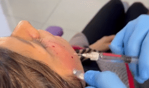 نمونه تزریق مزوژل دکتر محسن پورآریا