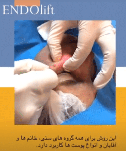 نمونه اندولیفت گروه پزشکی آریا