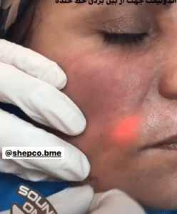 نمونه اندولیفت گروه پزشکی آریا