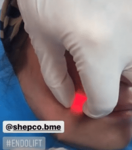 نمونه اندولیفت گروه پزشکی آریا