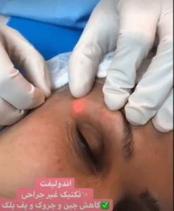 نمونه اندولیفت گروه پزشکی آریا