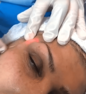 نمونه اندولیفت گروه پزشکی آریا