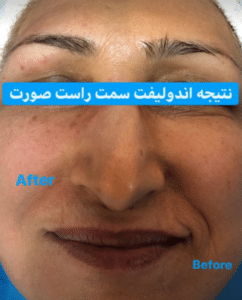 نمونه اندولیفت گروه پزشکی آریا