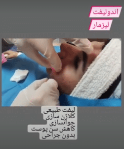 نمونه اندولیفت گروه پزشکی آریا