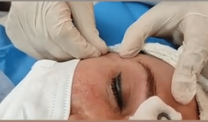 نمونه اندولیفت گروه پزشکی آریا