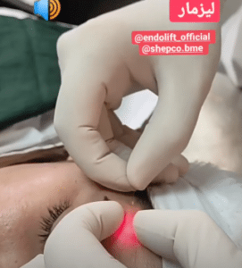 نمونه اندولیفت گروه پزشکی آریا