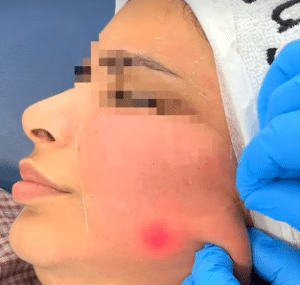 نمونه اندولیفت دکتر محسن پورآریا