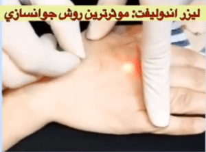 نمونه لیزر اندولیفت دکتر قاسم رحمت پور رکنی