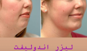 نمونه لیزر اندولیفت دکتر قاسم رحمت پور رکنی