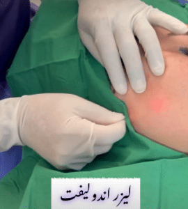 نمونه لیزر اندولیفت دکتر قاسم رحمت پور رکنی