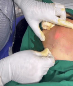 نمونه لیزر اندولیفت دکتر قاسم رحمت پور رکنی