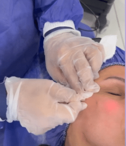 نمونه لیزر اندولیفت دکتر قاسم رحمت پور رکنی