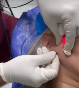 نمونه لیزر اندولیفت دکتر قاسم رحمت پور رکنی