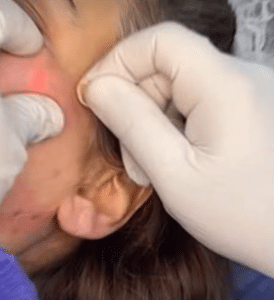 نمونه لیزر اندولیفت دکتر قاسم رحمت پور رکنی