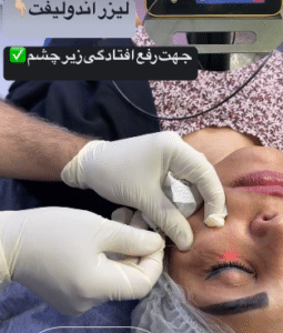 نمونه لیزر اندولیفت دکتر قاسم رحمت پور رکنی