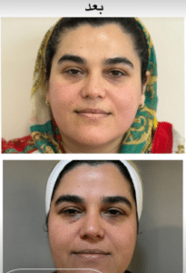 نمونه آر اف فرکشنال دکتر آرزو عوض پور (کلینیک زیبایی افسون)