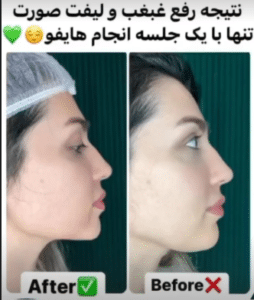 نمونه هایفوتراپی کلینیک زیبایی کاژه