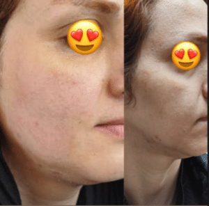 نمونه هایفوتراپی کلینیک زیبایی کاژه