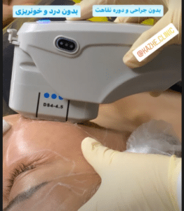 نمونه هایفوتراپی کلینیک زیبایی کاژه