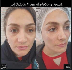 نمونه هایفوتراپی کلینیک زیبایی کاژه