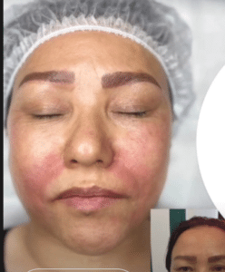 نمونه هایفوتراپی کلینیک زیبایی کاژه