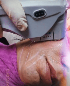 نمونه هایفوتراپی کلینیک زیبایی کاژه