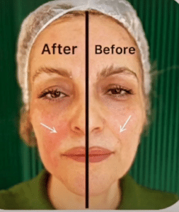 نمونه هایفوتراپی کلینیک زیبایی کاژه