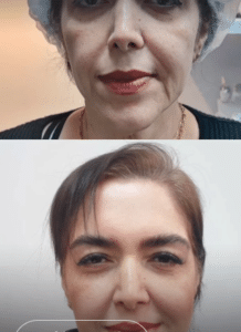 نمونه هایفوتراپی کلینیک زیبایی کاژه