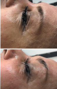 نمونه هایفوتراپی کلینیک زیبایی پردیسان